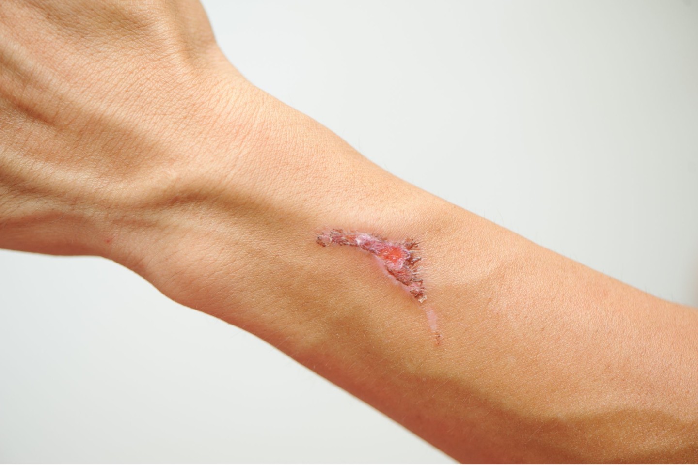 Infizierte Wunden wie Schnittverletzungen oder Insektenstiche können schon zu einer Sepsis führen, daher ist Hygiene und eine gute Wunddesinfektion wichtig. Foto: AOK/hfr.