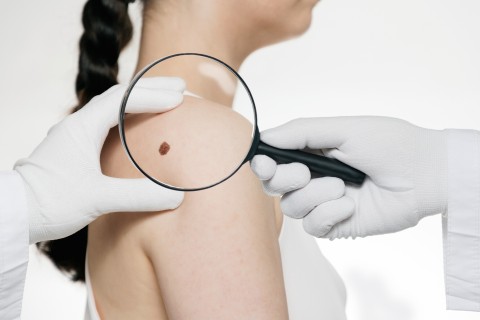 Hautkrebs-Screening im Kreis Höxter wieder mehr genutzt